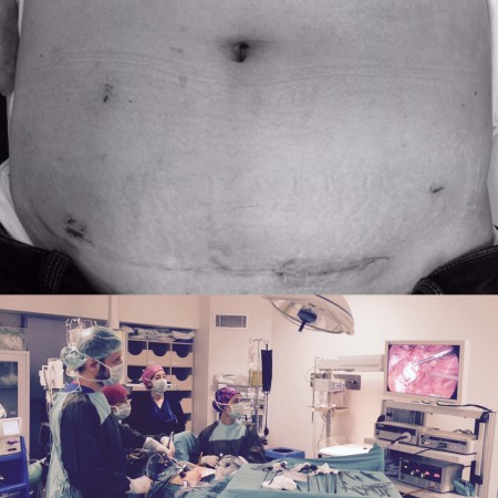 Laparoskopik sigmoid kolon rezeksiyonu ( kapalı yöntemle barsak ameliyatı)